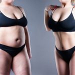 breast lift after weight loss