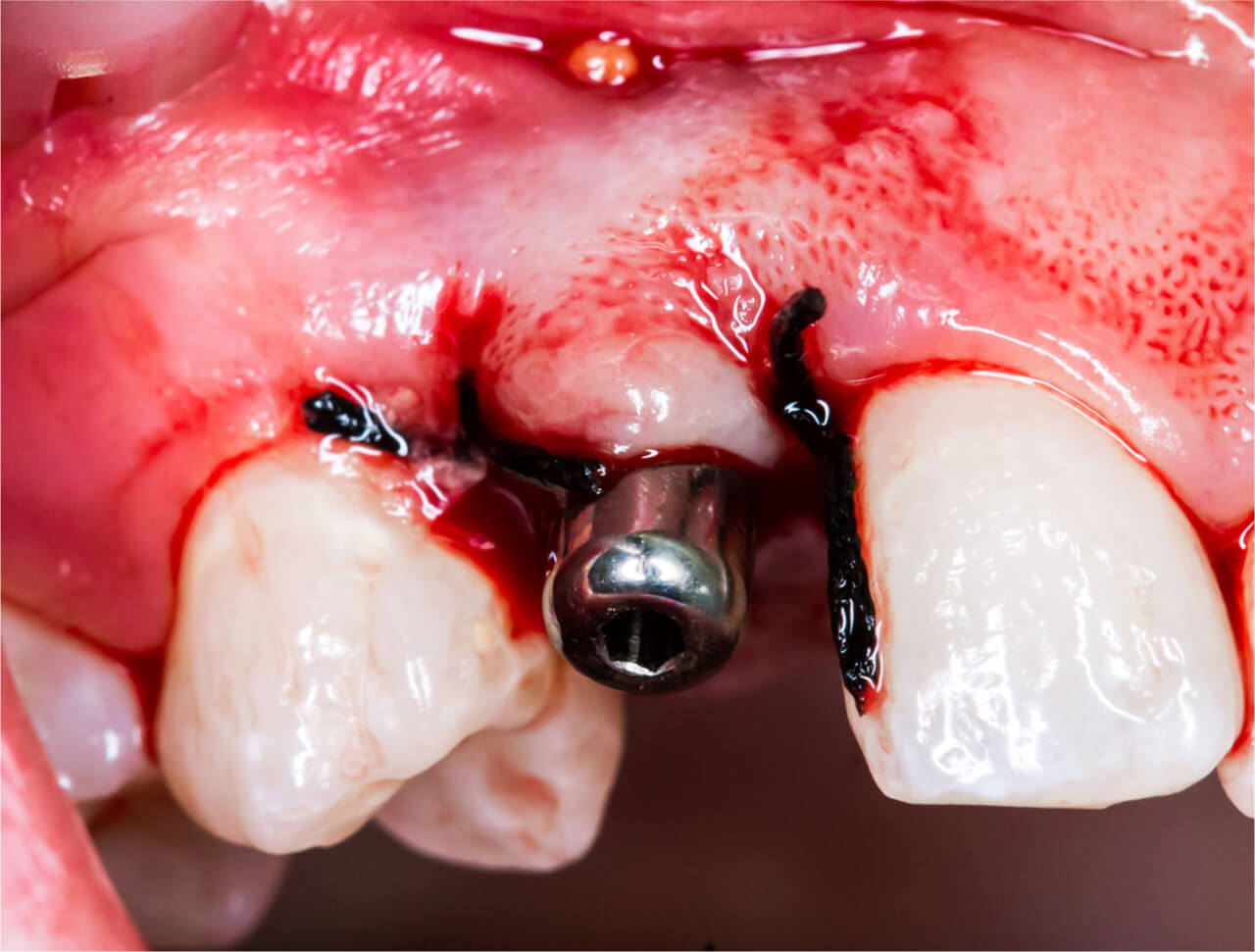 dental implant infections