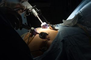 roux-en-y gastric bypass surgery