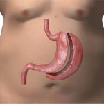 sleeve gastrectomy side effects