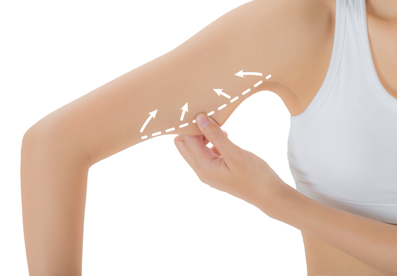 arm liposuction