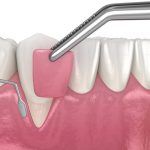 gum grafting procedure to address receding gums